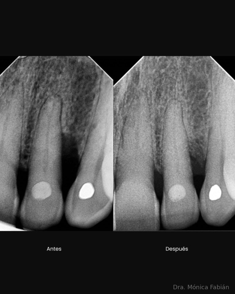 Before and after — radiographic follow-up · Dr. Samir Tiapa · DensCare