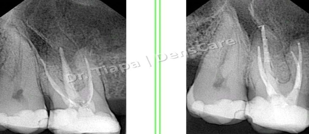 Canal undetected in previous treatment without microscope