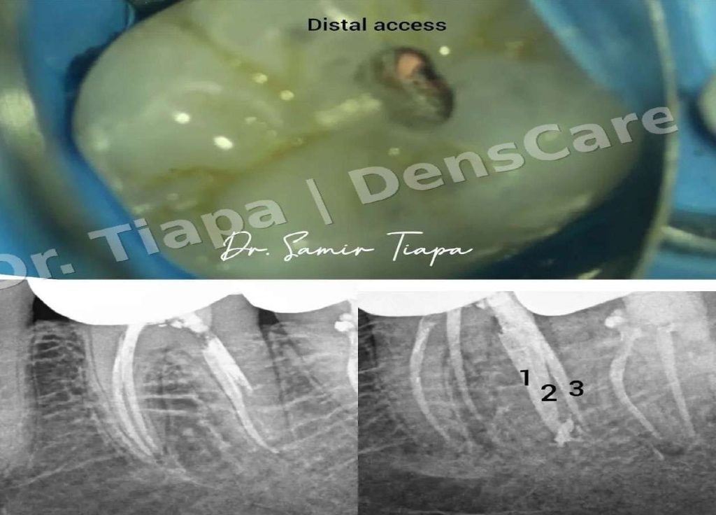Microscope view of distal access