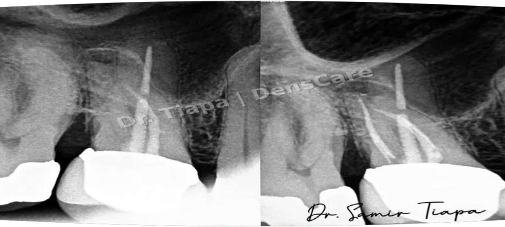 Periapical X-rays pre (left) and post (right) retreatment