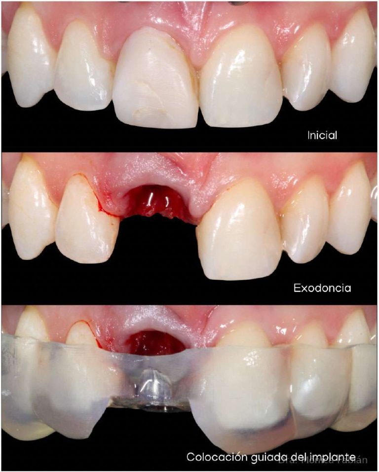 Postoperative result