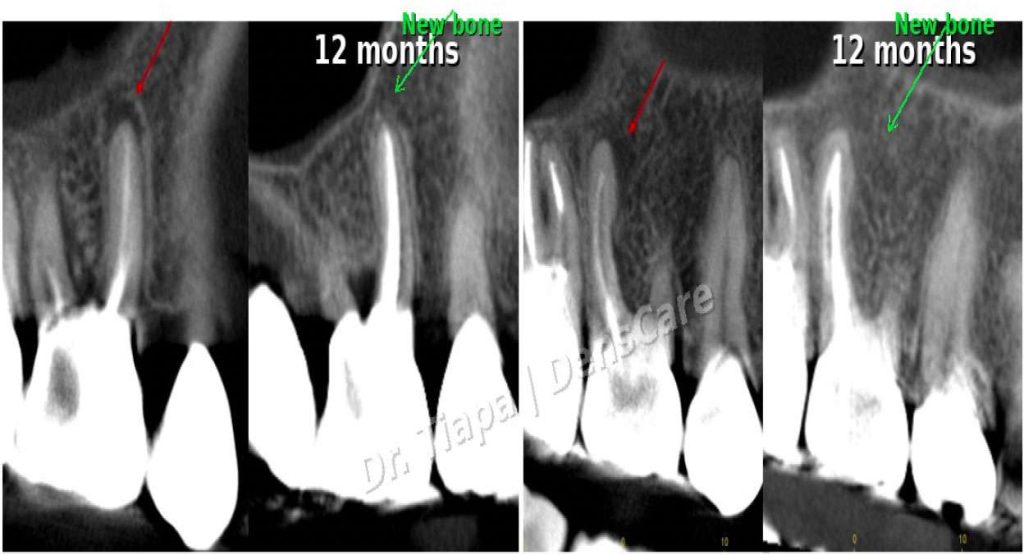 Pre (left) and post (right) retreatment X-rays