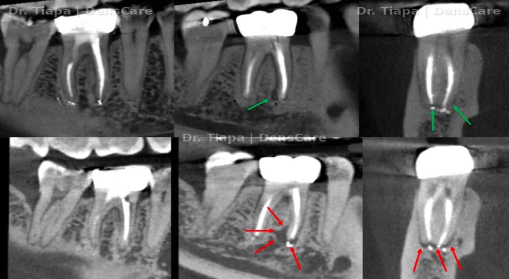 Red arrows: active periapical lesion from cross-contamination