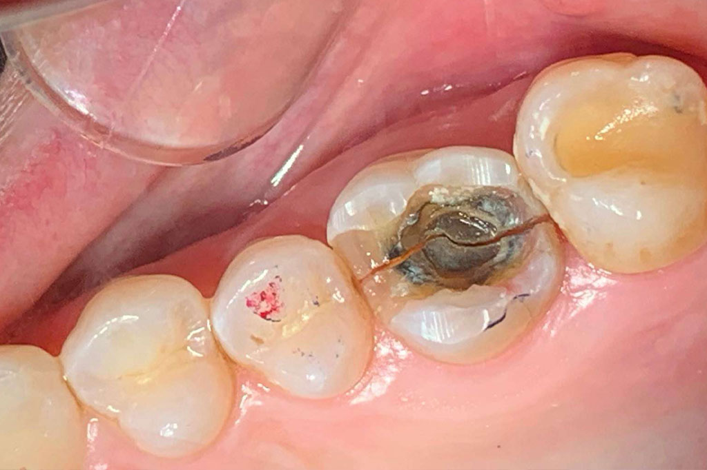 Tooth Fracture