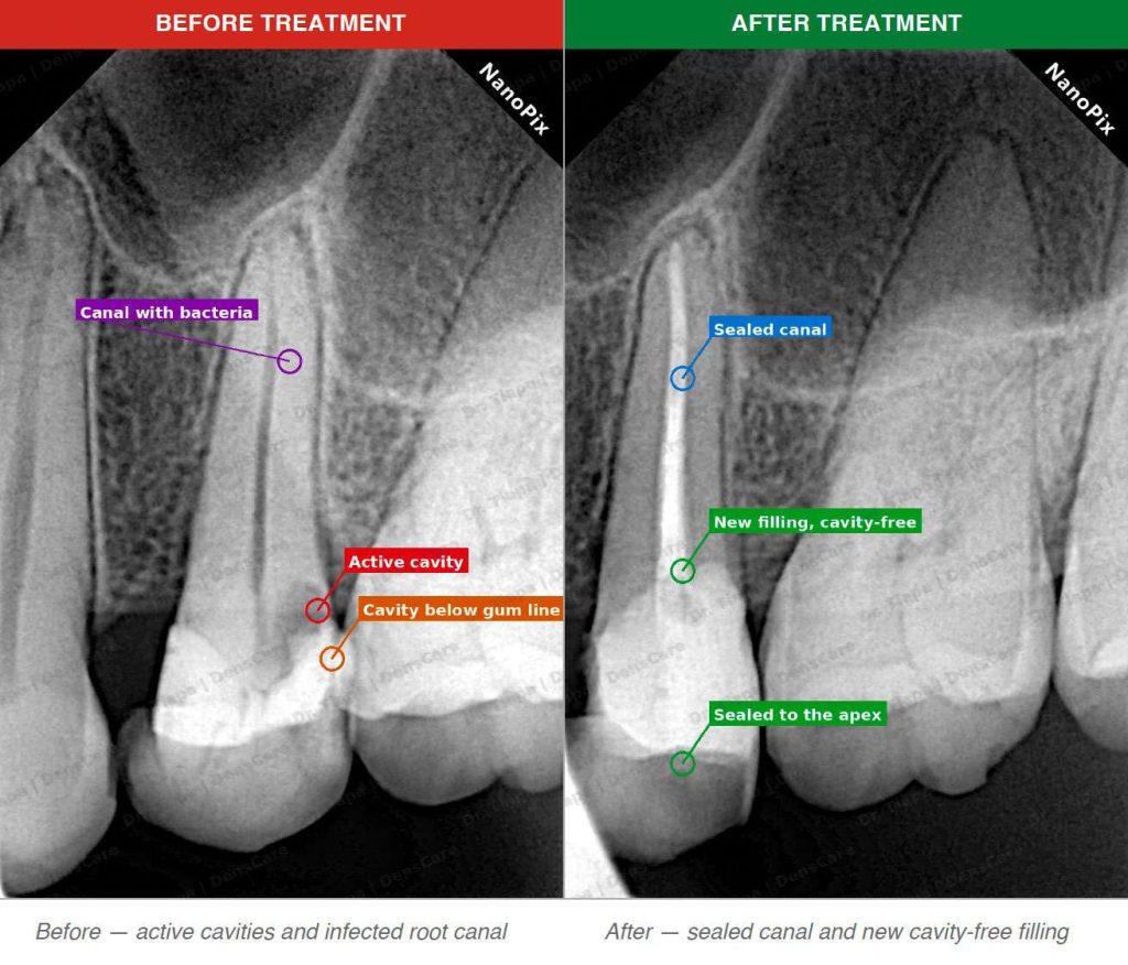active cavities and infected root canal