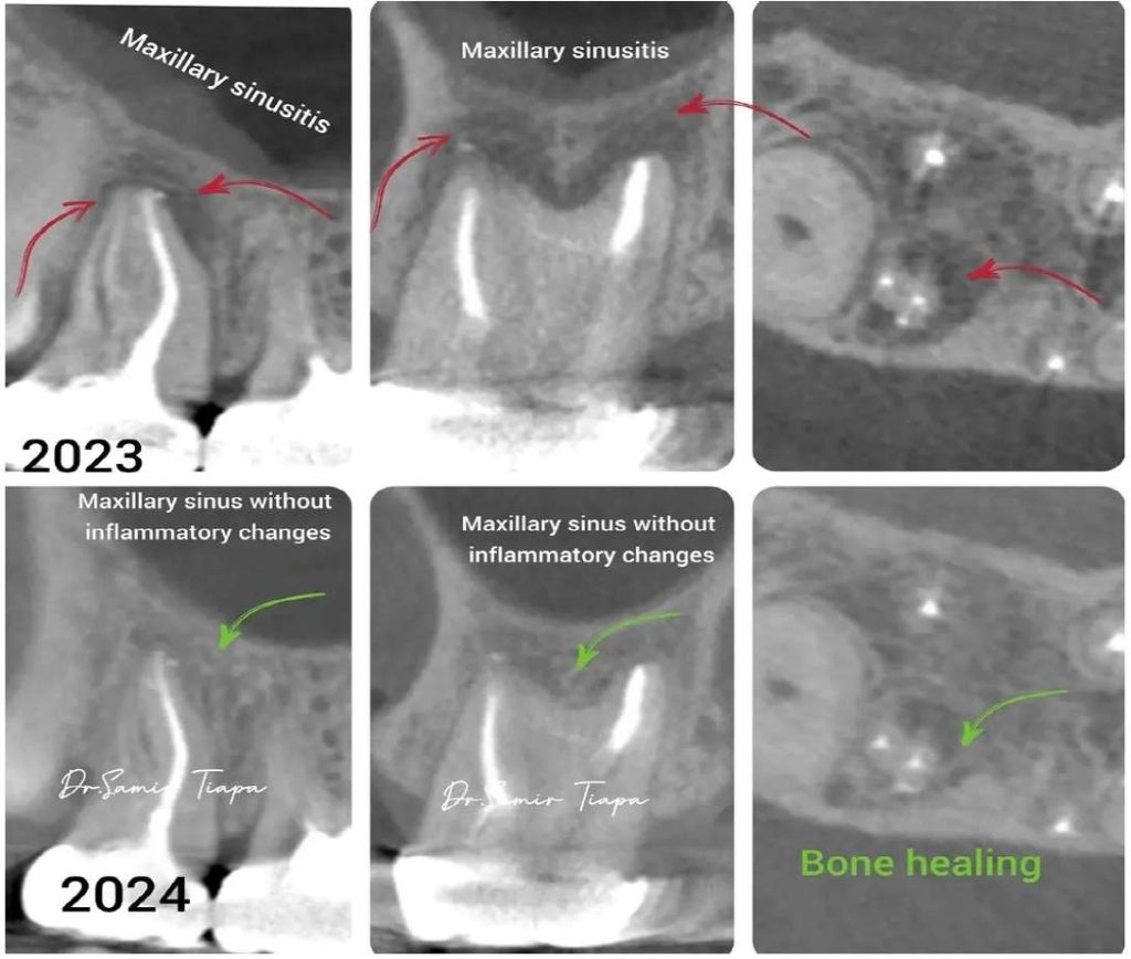 Active maxillary sinusitis with sinus opacification and periapical lesion