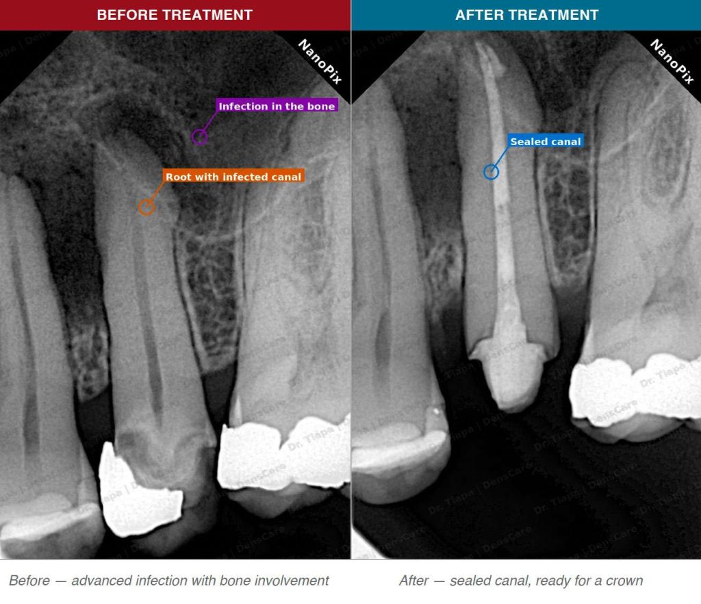 advanced infection with bone involvement