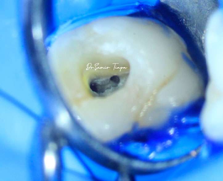 Microscopic view: canal identification inside the pulp chamber
