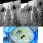 Panel: pre/post X-rays and clinical view — conservative access with 4 canals identified