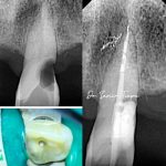 Annotated X-ray: deep decay with irreversible pulp damage — diagnosed under the microscope