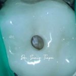Minimal access in an anterior tooth: maximum preservation of healthy tissue