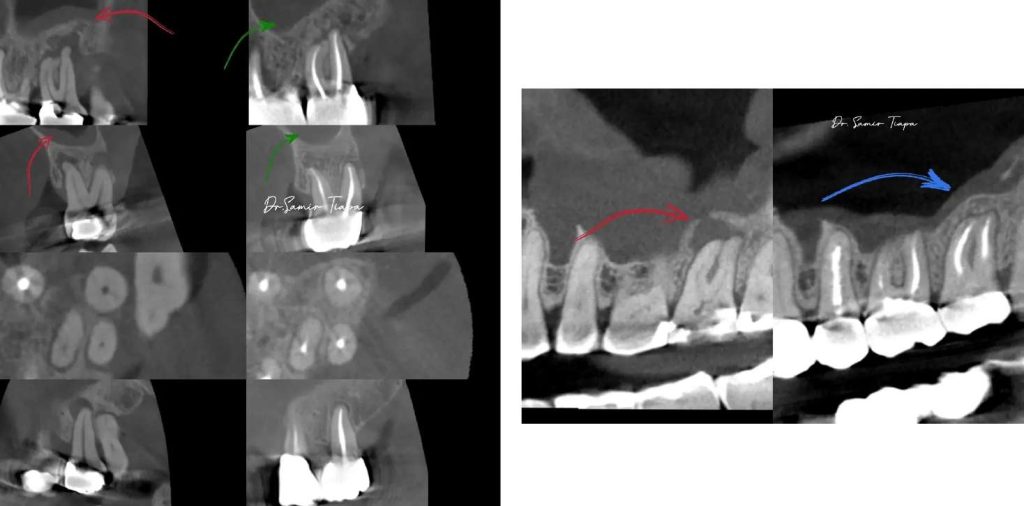 Periapical bone loss fully resolved
