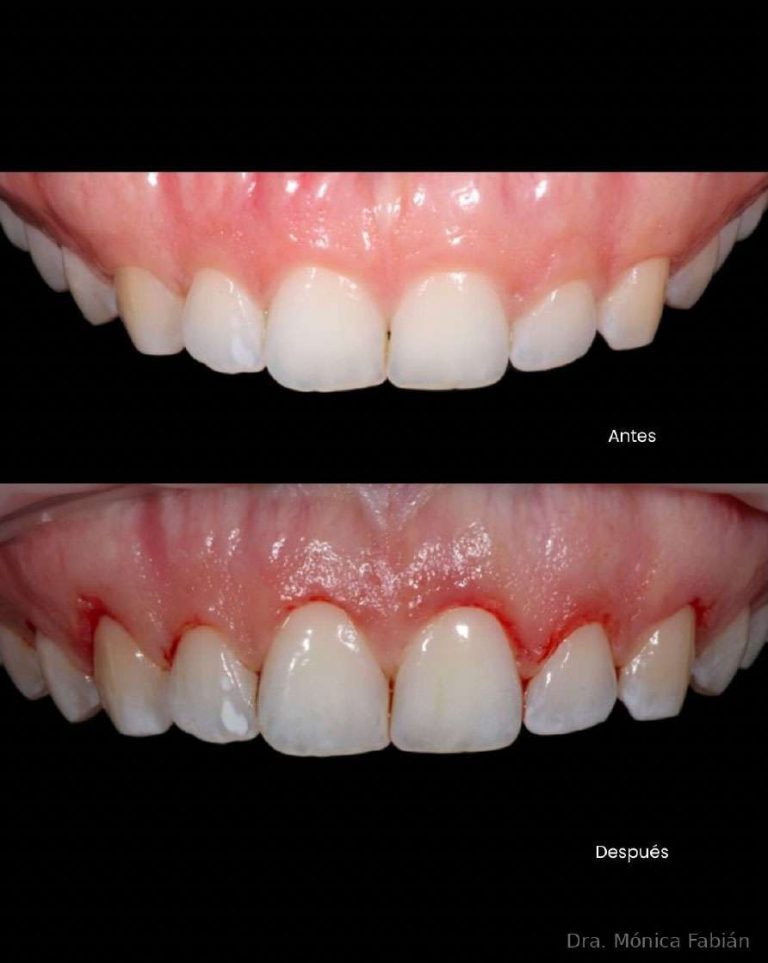 Before — short teeth, irregular margin