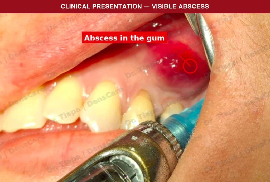 visible abscess in the gum at the time of the emergency