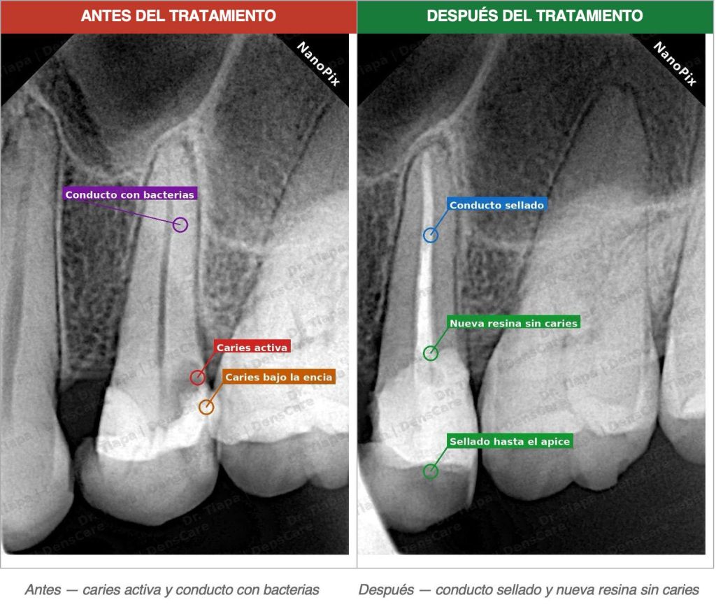 Caso 1 — Absceso activo con caries subgingival