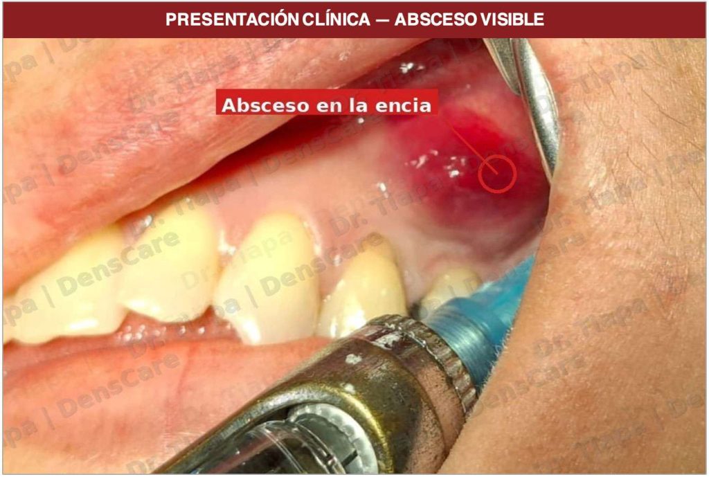 Caso 2 — Absceso avanzado con lesión en el hueso
