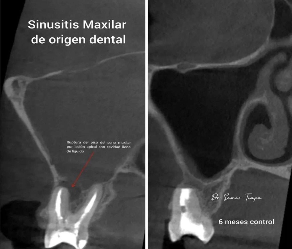 Ruptura del piso del seno maxilar